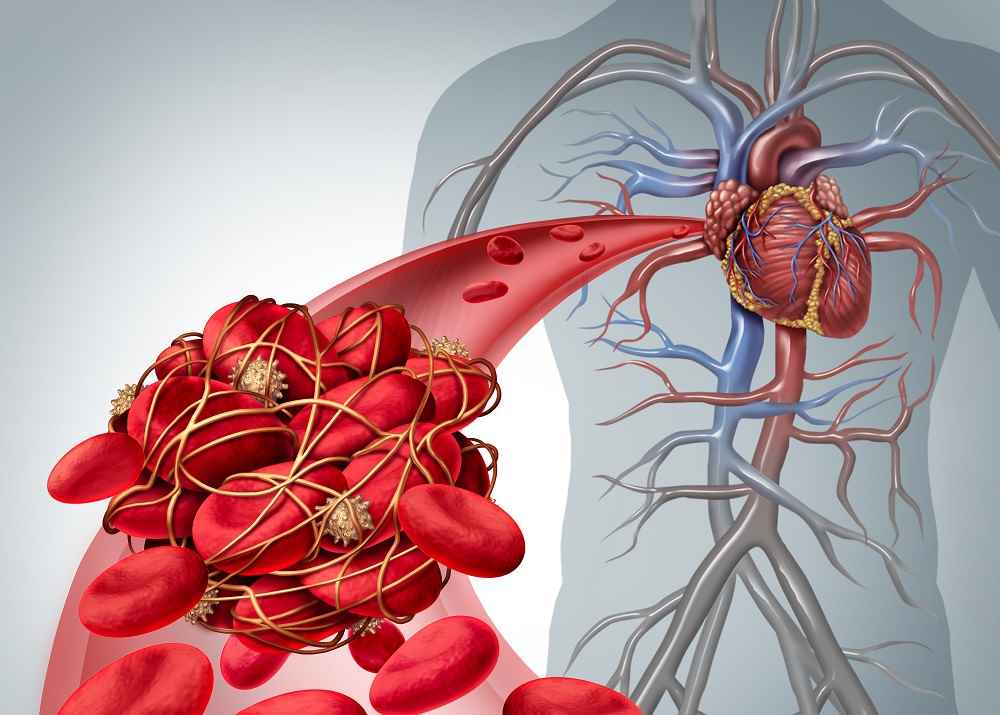 omocisteina-alta-rischio-cardiovascolare