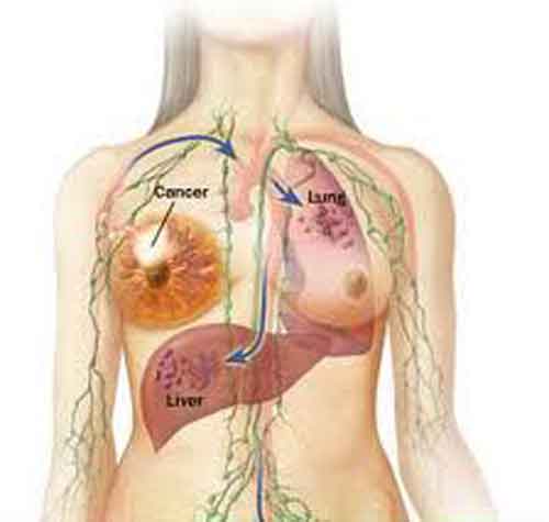Diffusione del tumore dal tessuto mammario ai polmoni